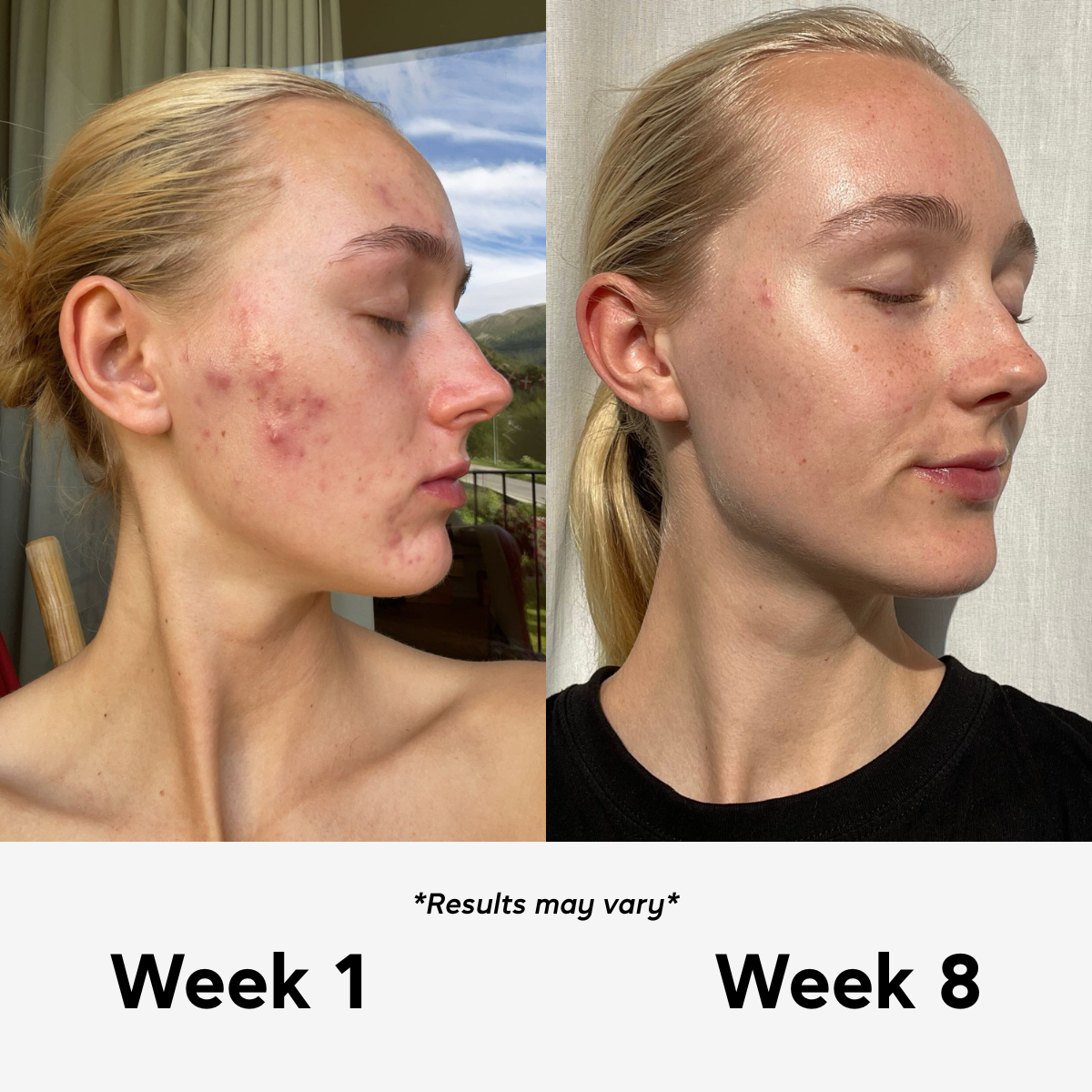Acne Reset Ritual
